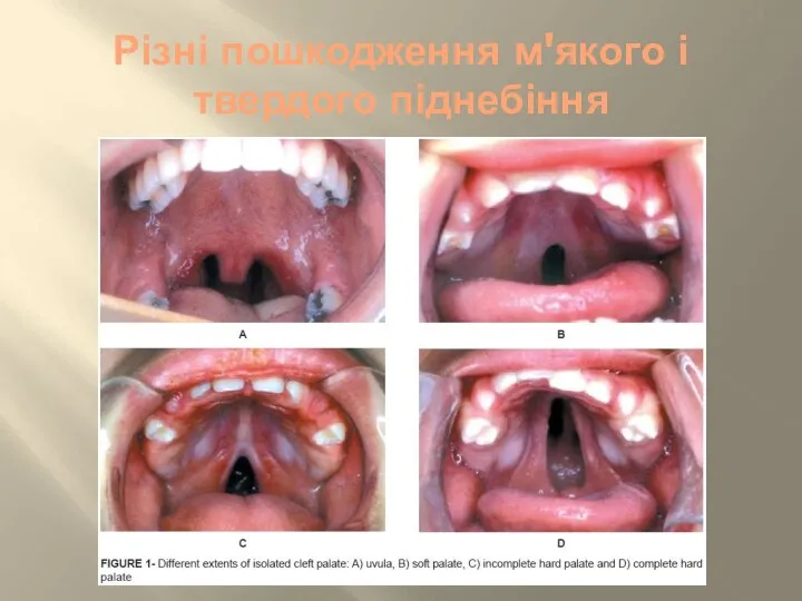 Різні пошкодження м'якого і твердого піднебіння