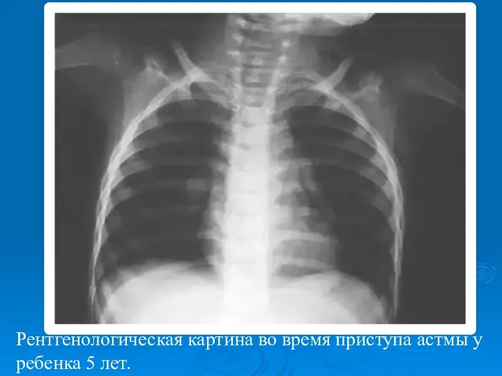 Рентгенологическая картина во время приступа астмы у ребенка 5 лет.