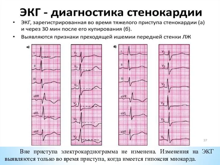 Вне приступа электрокардиограмма не изменена. Изменения на ЭКГ выявляются только во