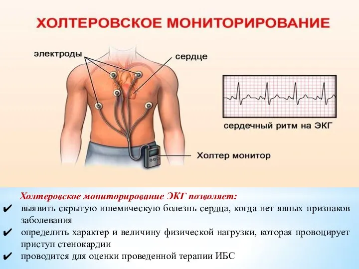 Холтеровское мониторирование ЭКГ позволяет: выявить скрытую ишемическую болезнь сердца, когда нет
