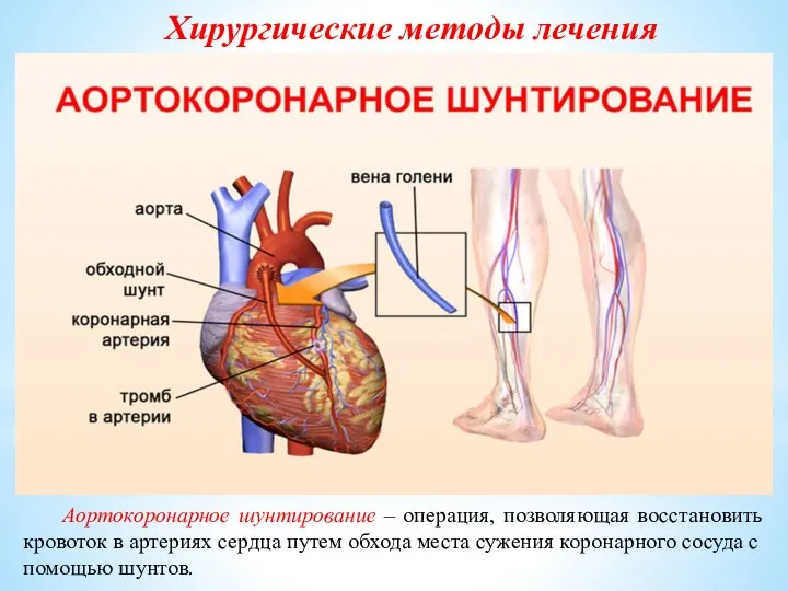 Хирургические методы лечения Аортокоронарное шунтирование – операция, позволяющая восстановить кровоток в