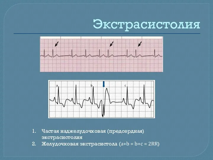 Экстрасистолия Частая наджелудочковая (предсердная) экстрасистолия Желудочковая экстрасистола (a+b = b+c = 2RR)