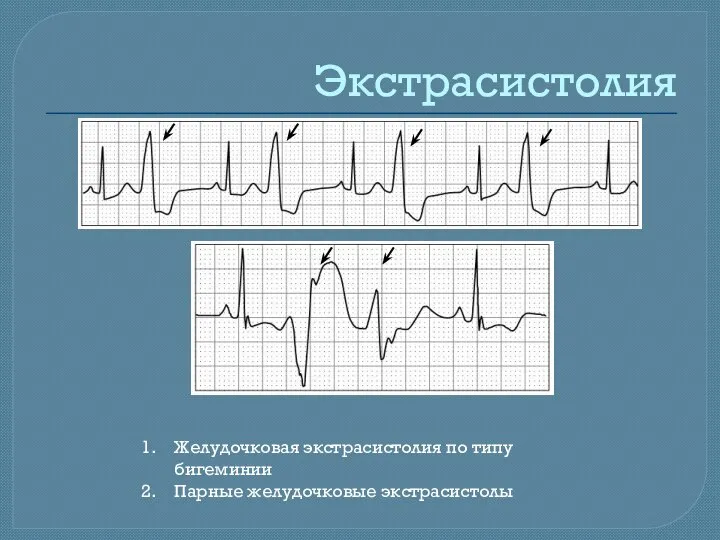 Экстрасистолия Желудочковая экстрасистолия по типу бигеминии Парные желудочковые экстрасистолы