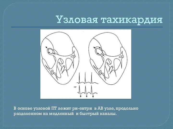 Узловая тахикардия В основе узловой ПТ лежит ри-ентри в АВ узле,