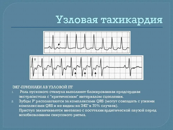 Узловая тахикардия ЭКГ-ПРИЗНАКИ АВ УЗЛОВОЙ ПТ Роль пускового стимула выполняет блокированная