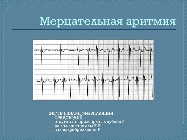 Мерцательная аритмия ЭКГ-ПРИЗНАКИ ФИБРИЛЛЯЦИИ ПРЕДСЕРДИЙ отсутствие предсердных зубцов Р разные интервалы R-R волны фибрилляции F