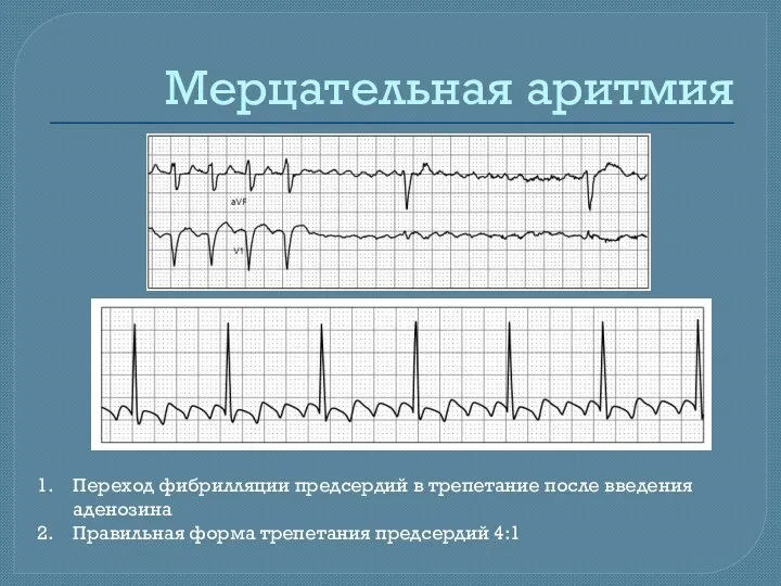 Мерцательная аритмия Переход фибрилляции предсердий в трепетание после введения аденозина Правильная форма трепетания предсердий 4:1