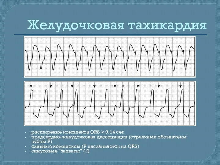 Желудочковая тахикардия расширение комплекса QRS > 0.14 сек предсердно-желудочковая диссоциация (стрелками