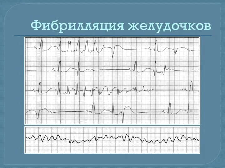 Фибрилляция желудочков