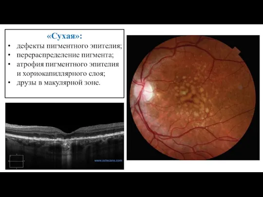 «Сухая»: дефекты пигментного эпителия; перераспределение пигмента; атрофия пигментного эпителия и хориокапиллярного слоя; друзы в макулярной зоне.
