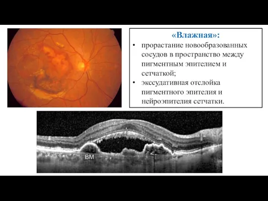 «Влажная»: прорастание новообразованных сосудов в пространство между пигментным эпителием и сетчаткой;