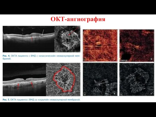ОКТ-ангиография