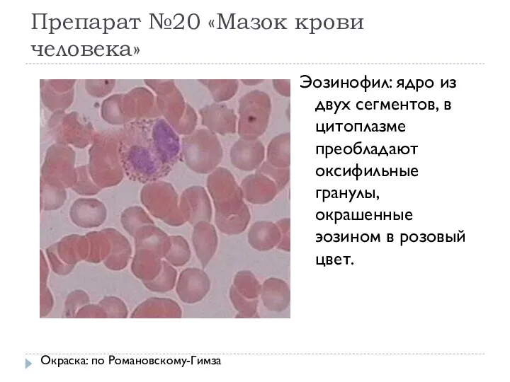 Препарат №20 «Мазок крови человека» Эозинофил: ядро из двух сегментов, в