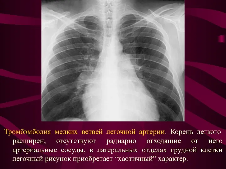 Тромбэмболия мелких ветвей легочной артерии. Корень легкого расширен, отсутствуют радиарно отходящие