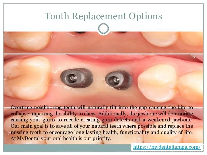 Tooth Replacement Options Overtime neighboring teeth will naturally tilt into the