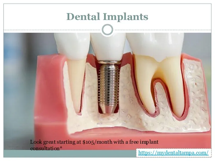 Dental Implants Look great starting at $105/month with a free implant consultation* https://mydentaltampa.com/