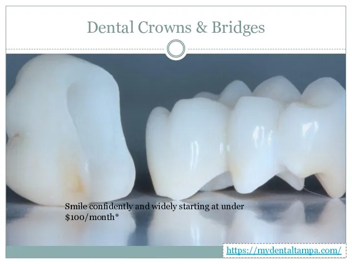 Dental Crowns & Bridges Smile confidently and widely starting at under $100/month* https://mydentaltampa.com/