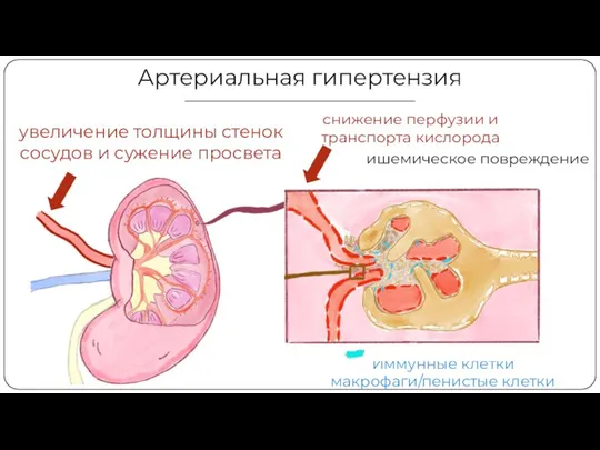 Артериальная гипертензия увеличение толщины стенок сосудов и сужение просвета снижение перфузии