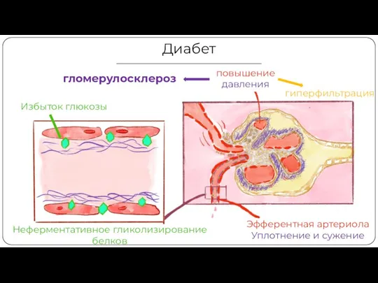 Диабет Неферментативное гликолизирование белков Эфферентная артериола Уплотнение и сужение повышение давления гиперфильтрация гломерулосклероз Избыток глюкозы