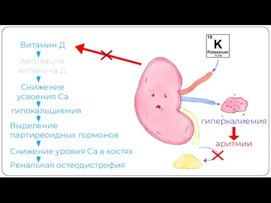 гиперкалиемия аритмии Активация витамина Д Витамин Д Активация витамина Д Снижение