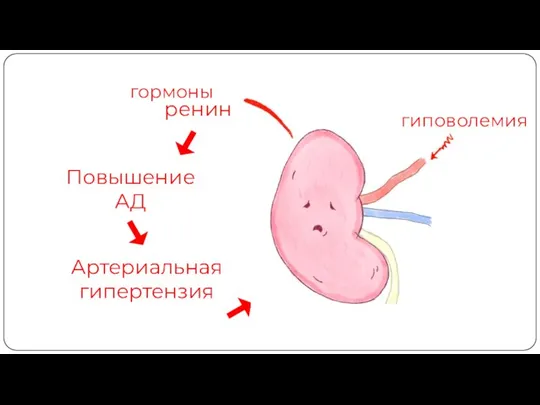 гормоны ренин Повышение АД Артериальная гипертензия гиповолемия