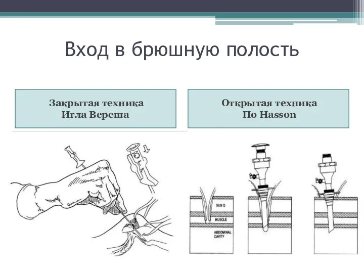 Вход в брюшную полость Закрытая техника Игла Вереша Открытая техника По Hasson