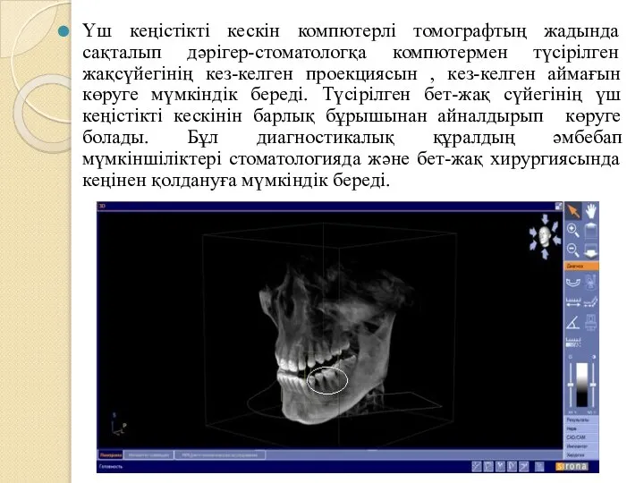 Үш кеңістікті кескін компютерлі томографтың жадында сақталып дәрігер-стоматологқа компютермен түсірілген жақсүйегінің