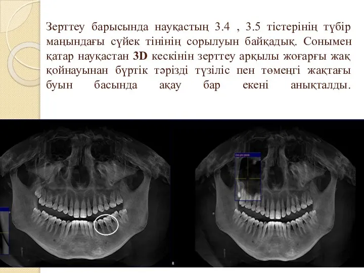 Зерттеу барысында науқастың 3.4 , 3.5 тістерінің түбір маңындағы сүйек тінінің