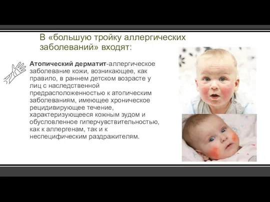 В «большую тройку аллергических заболеваний» входят: Атопический дерматит-аллергическое заболевание кожи, возникающее,