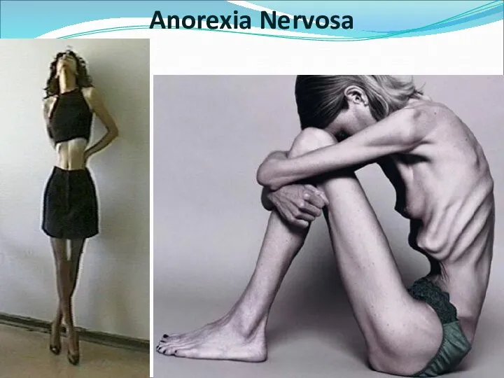 Anorexia Nervosa