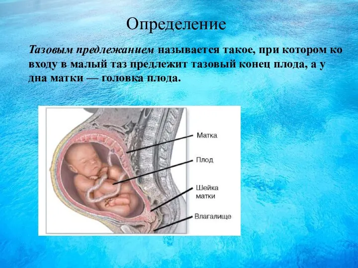 Определение Тазовым предлежанием называется такое, при котором ко входу в малый