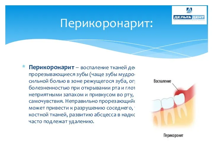 Перикоронарит – воспаление тканей десны, окружающих прорезывающиеся зубы (чаще зубы мудрости).