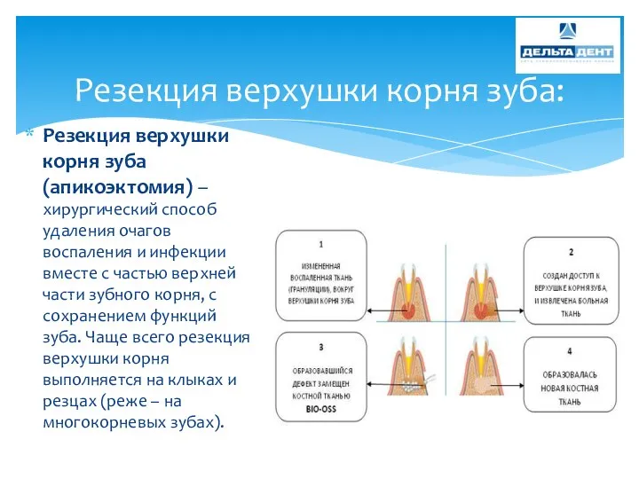 Резекция верхушки корня зуба (апикоэктомия) – хирургический способ удаления очагов воспаления