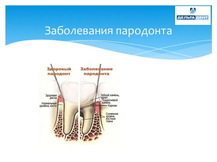 Заболевания пародонта