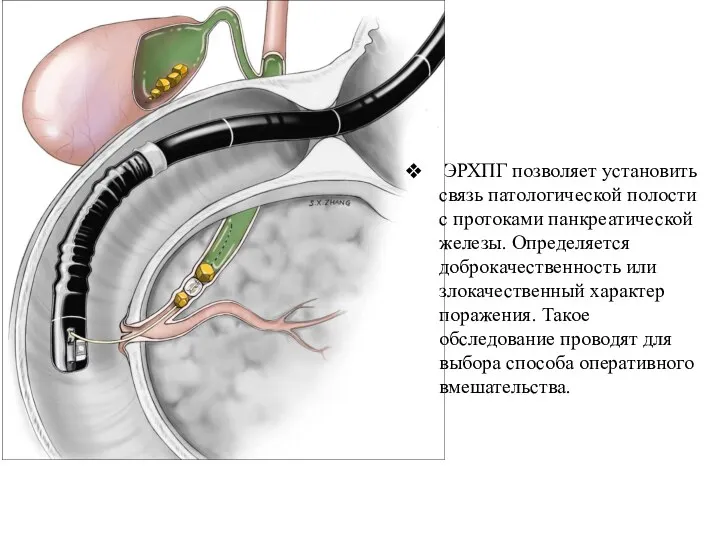 ЭРХПГ позволяет установить связь патологической полости с протоками панкреатической железы. Определяется