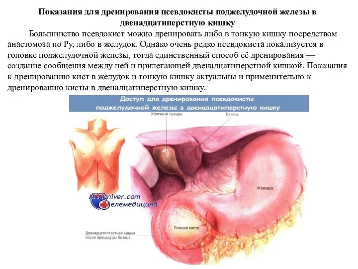 Показания для дренирования псевдокисты поджелудочной железы в двенадцатиперстную кишку Большинство псевдокист