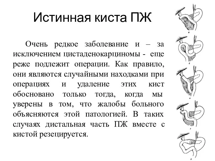 Истинная киста ПЖ Очень редкое заболевание и – за исключением цистаденокарциномы