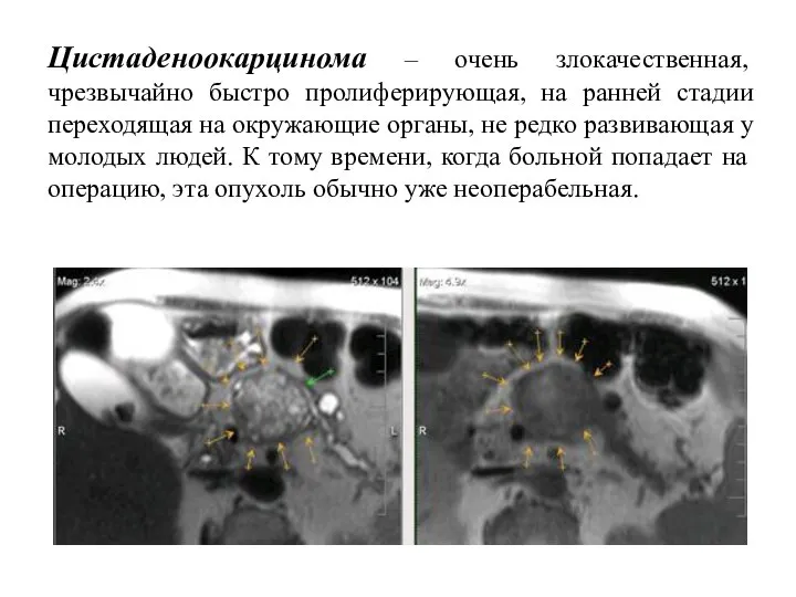 Цистаденоокарцинома – очень злокачественная, чрезвычайно быстро пролиферирующая, на ранней стадии переходящая