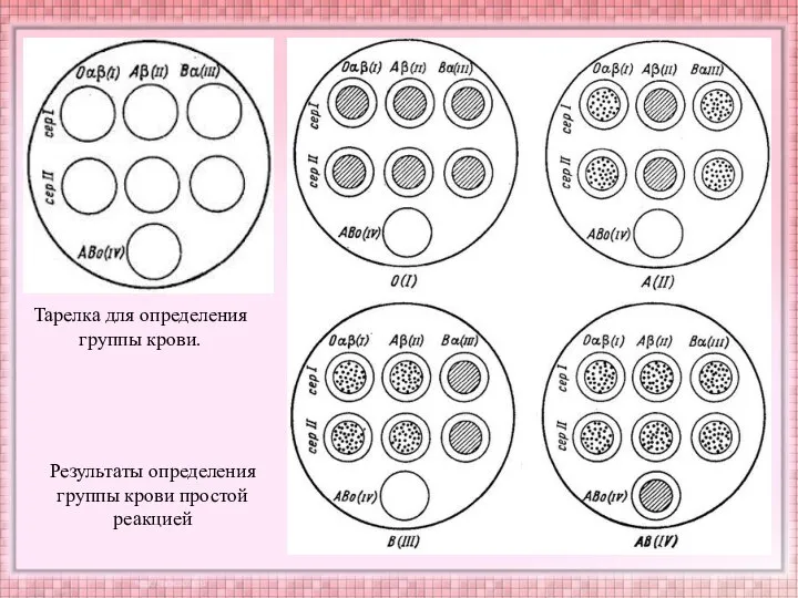 Тарелка для определения группы крови. Результаты определения группы крови простой реакцией