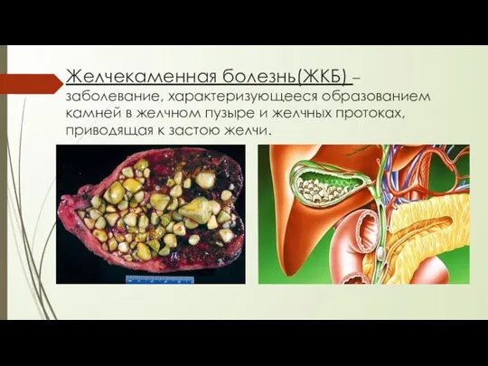 Желчекаменная болезнь(ЖКБ) – заболевание, характеризующееся образованием камней в желчном пузыре и