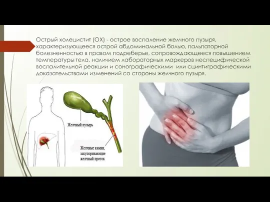 Острый холецистит (ОХ) - острое воспаление желчного пузыря, характеризующееся острой абдоминальной