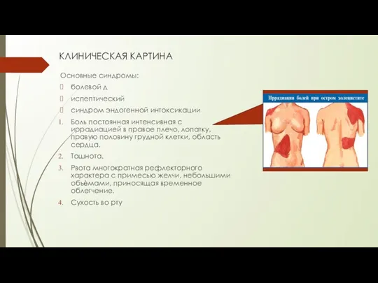 КЛИНИЧЕСКАЯ КАРТИНА Основные синдромы: болевой д испептический синдром эндогенной интоксикации Боль