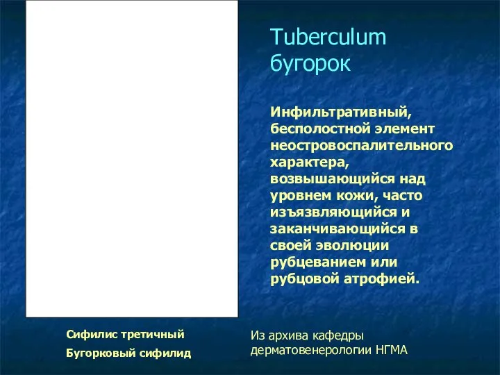 Tuberculum бугорок Инфильтративный, бесполостной элемент неостровоспалительного характера, возвышающийся над уровнем кожи,