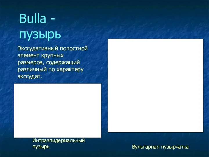 Bulla - пузырь Интраэпидермальный пузырь Экссудативный полостной элемент крупных размеров, содержащий