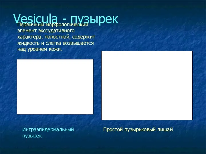 Vesicula - пузырек Простой пузырьковый лишай Интраэпидермальный пузырек Первичный морфологический элемент