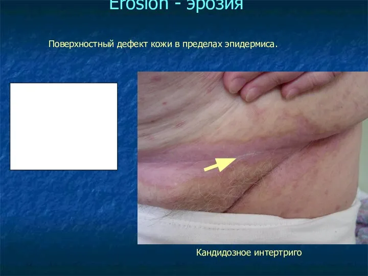 Erosion - эрозия Поверхностный дефект кожи в пределах эпидермиса. Кандидозное интертриго