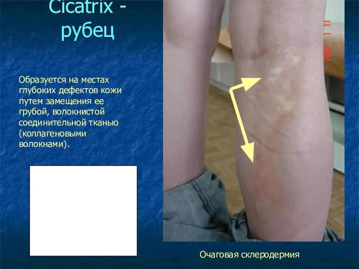 Cicatrix - рубец Очаговая склеродермия Образуется на местах глубоких дефектов кожи