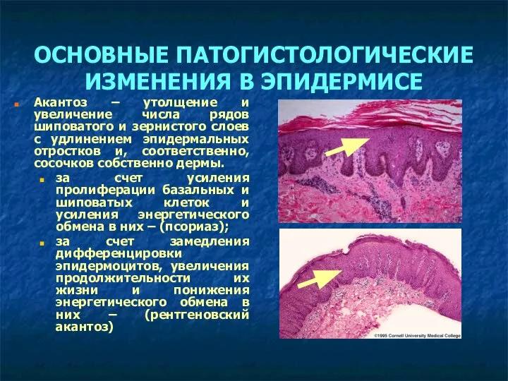 ОСНОВНЫЕ ПАТОГИСТОЛОГИЧЕСКИЕ ИЗМЕНЕНИЯ В ЭПИДЕРМИСЕ Акантоз – утолщение и увеличение числа