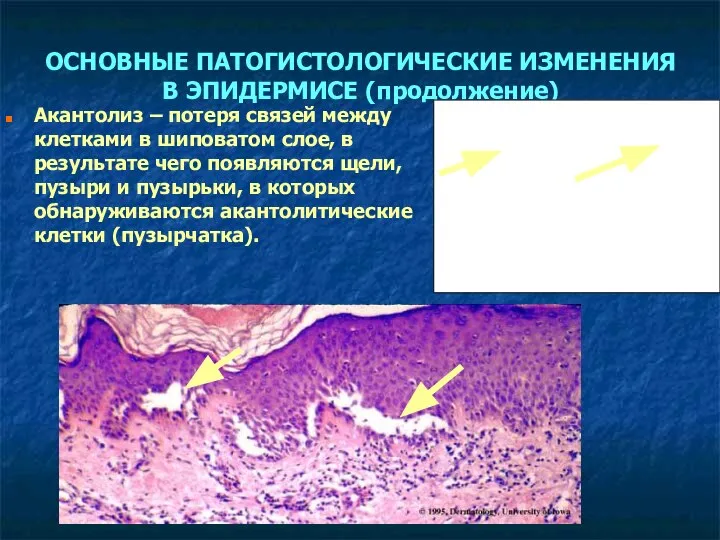 ОСНОВНЫЕ ПАТОГИСТОЛОГИЧЕСКИЕ ИЗМЕНЕНИЯ В ЭПИДЕРМИСЕ (продолжение) Акантолиз – потеря связей между