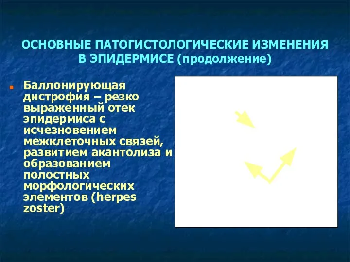 ОСНОВНЫЕ ПАТОГИСТОЛОГИЧЕСКИЕ ИЗМЕНЕНИЯ В ЭПИДЕРМИСЕ (продолжение) Баллонирующая дистрофия – резко выраженный